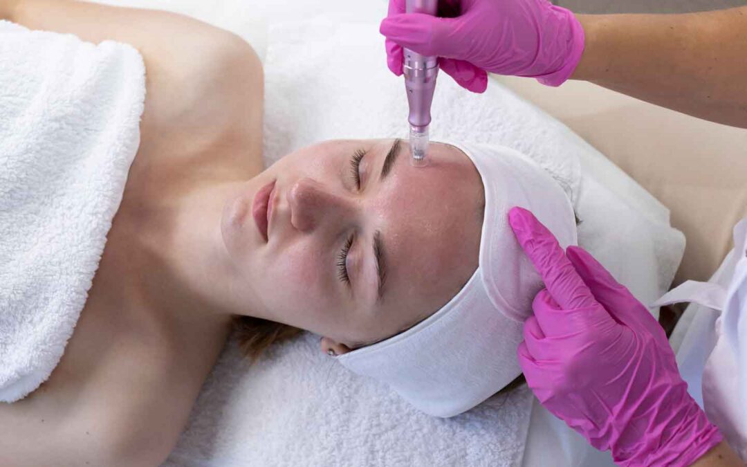 Microneedling